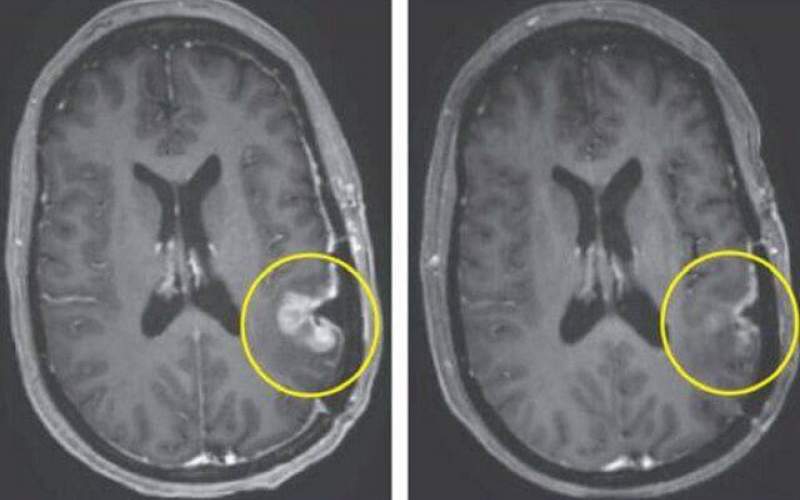 درمان باورنکردنی تومور مغزی تنها در ۵ روز